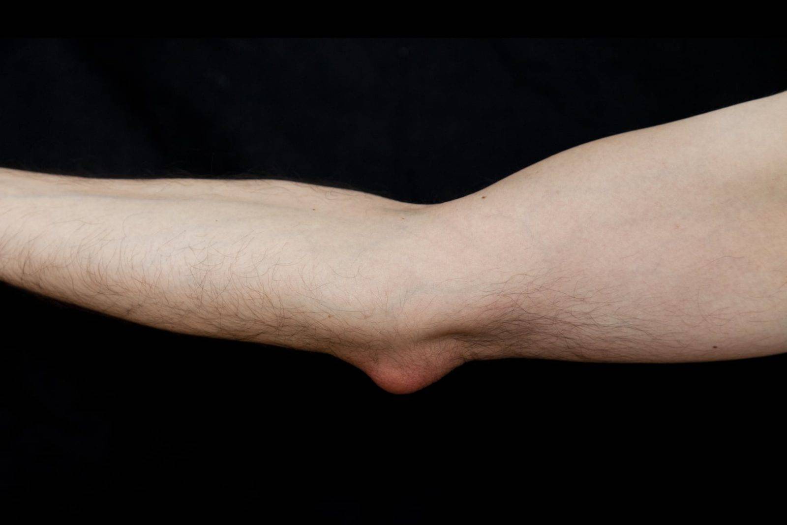 Elbow Bursitis Treatment in Knoxville, TN - Omega Pain Doctor