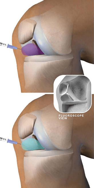 Knee joint injection in Knoxville, TN