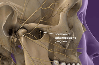 Sphenopalatine ganglion block - Knoxville, TN
