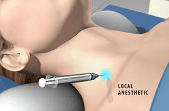 Stellate Ganglion Block (SGB) - Knoxville, TN