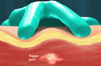 What is a trigger point injection