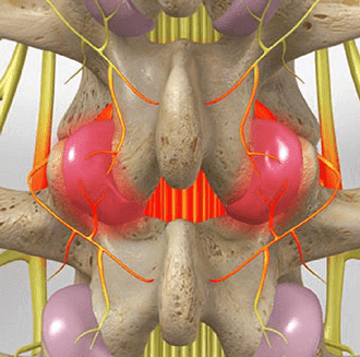 Medial branch block in Knoxville, TN