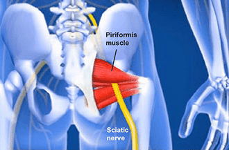 Piriformis muscle injection in Knoxville, TN