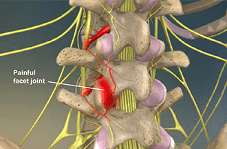 Radiofrequency ablation in Knoxville, TN