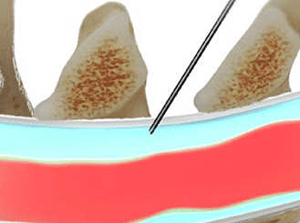 Cervical Epidural Steroid Injection in Knoxville, TN