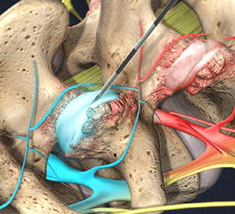 Facet joint injection procedure in Knoxville