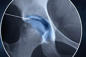 Hip joint injection procedure - Knoxville, TN