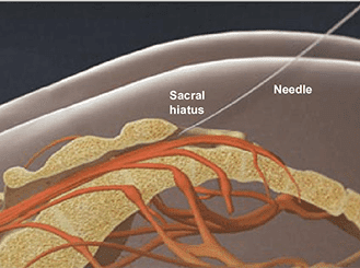 Caudal Steroid Injection Procedure - Knoxville Omega Pain Management