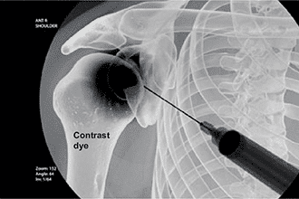 Shoulder injection in Knoxville - Shoulder pain treatment