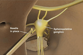 Sphenopalatine ganglion block injection - Knoxville, TN
