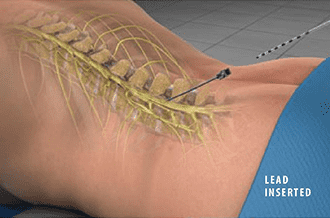 Pain Relief via a Spinal Cord Stimulator