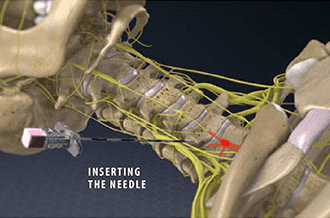 Stellate Ganglion Block in Knoxville, TN