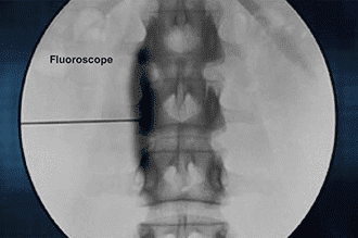 Lumbar sympathetic block in Knoxville, TN