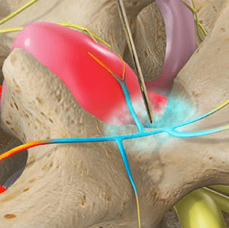 Medial branch block injection in Knoxville, Tennessee