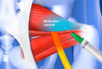 Piriformis injection in Knoxville, TN