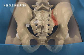 Sacroiliac joint injection procedure - Knoxville, TN