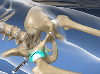 Hip joint injection in Knoxivlle, TN