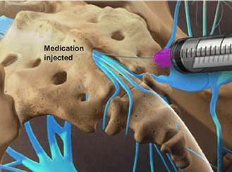 Caudal Steroid Injection in Knoxville Omega Pain Management