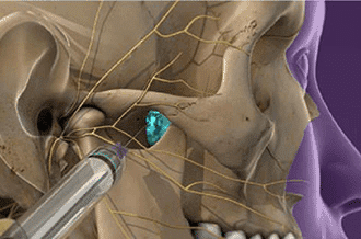 Sphenopalatine ganglion block - Knoxville, TN