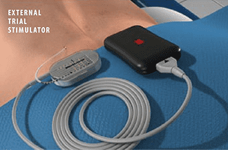 Spinal Cord Stimulator Trial - Omega Pain Management