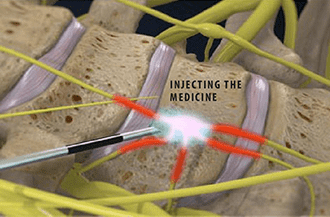 Stellate ganglion block procedure in Knoxville, TN pain clinic