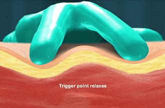 Trigger point injections in Knoxville, TN pain clinic