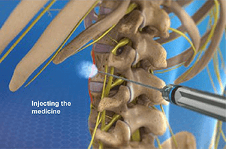 Lumbar sympathetic nerve block in Knoxville, TN