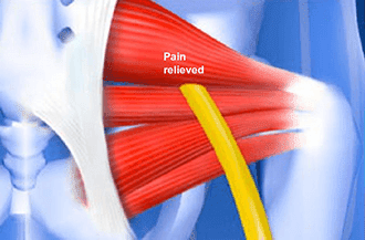 Piriformis Muscle Injection in Knoxville - Omega Pain Management