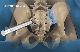 Sacroiliac joint injection - Knoxville, TN