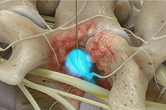 Selective nerve root block for sciatica treatment - Knoxville, TN