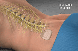 Spinal cord stimulator implantation - Knoxville, TN pain managenet clinic
