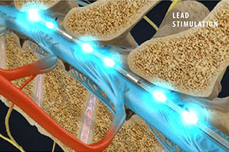 Spinal Cord Stimulator Trial - Omega Pain Management