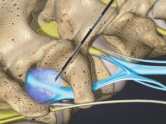 Lumbar Spine Epidural Steroid Injection in Knoxville