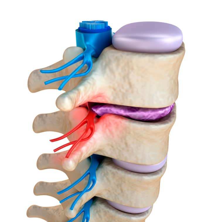 Treatment Options for a Budging Disc in Knoxville 