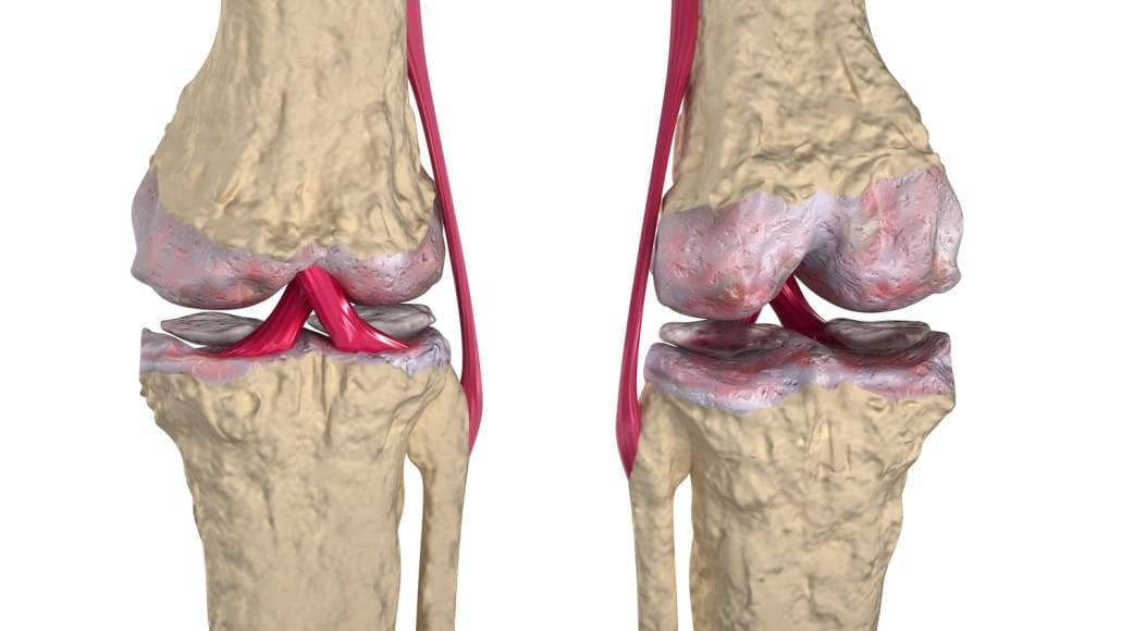 Osteoarthritis in Knoxville - Symptoms, Causes and Treatment Options