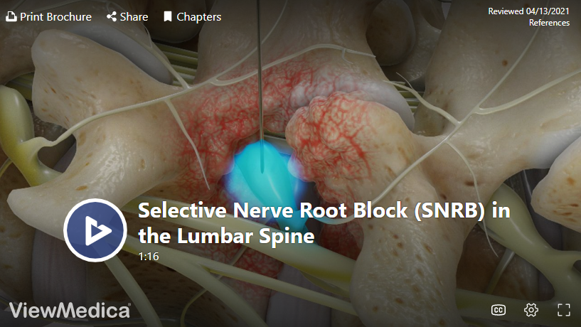 Selective Nerve Root Block in Knoxville - Omega Pain Management