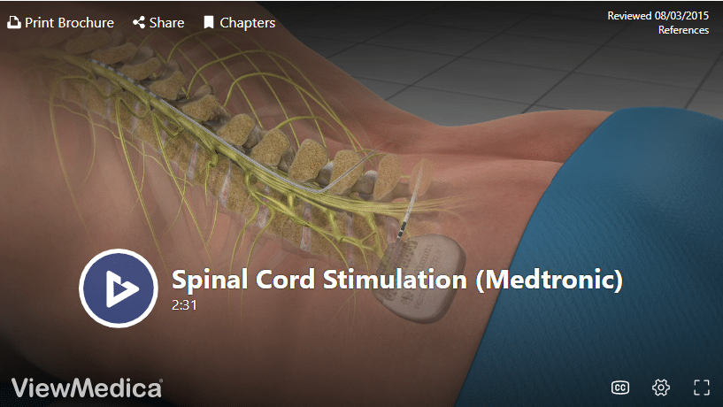 Spinal Cord Stimulator Trial - Omega Pain Management